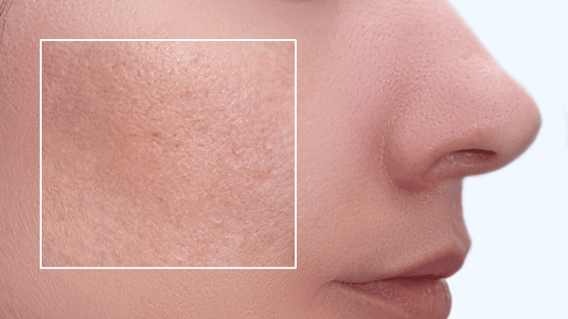 Kiềm dầu và se khít lỗ chân lông