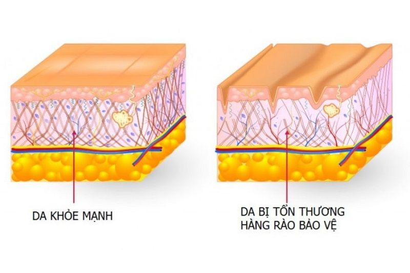 Hàng rào bảo vệ da (Skin Barrier) suy yếu