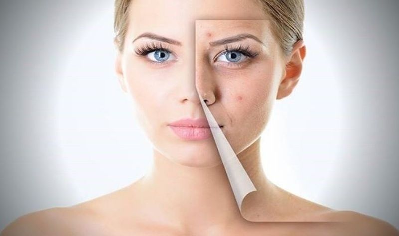 Làm dịu các nốt mụn sưng viêm