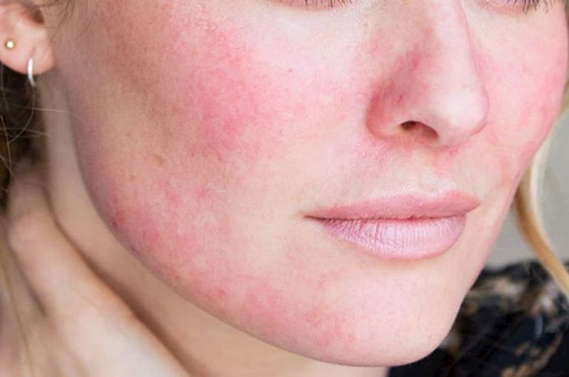Da có cảm giác ngứa, đỏ, sưng, bỏng rát