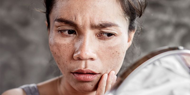 Các nguyên nhân nội sinh gây nám da