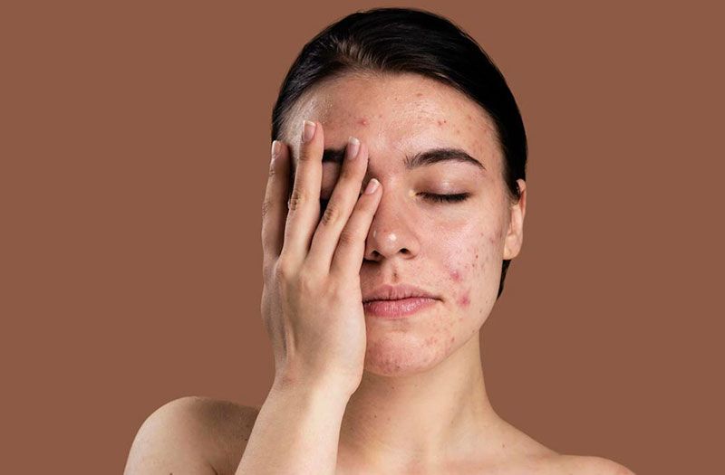 Mặt Nạ Thải Độc Là Gì & Tại Sao Da Nhạy Cảm Cần Nó