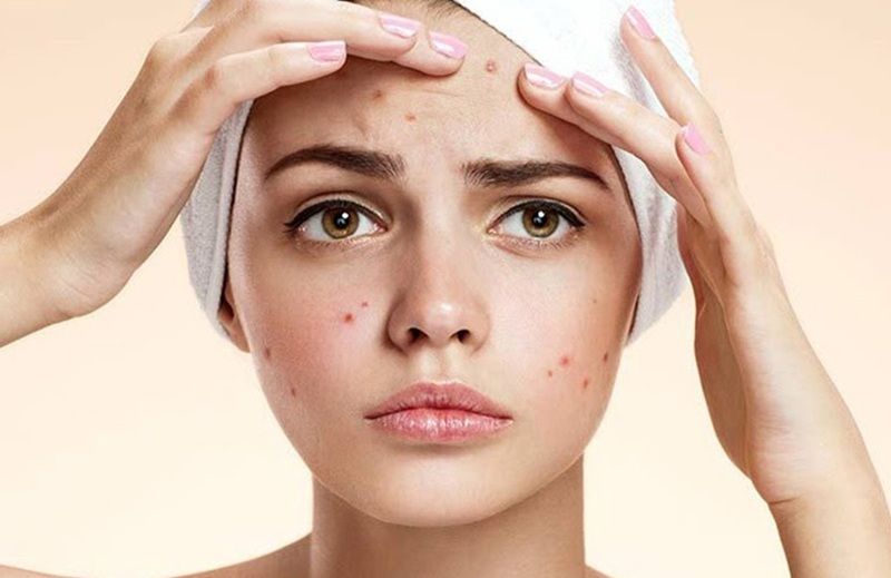 Mụn xuất hiện thường xuyên, nhiều hơn bình thường