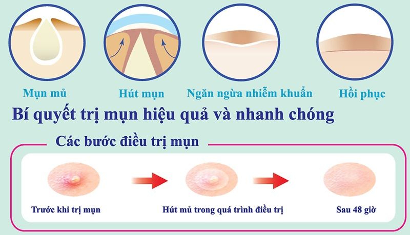 Cơ chế Hydrocolloid (Chất liệu chính)
