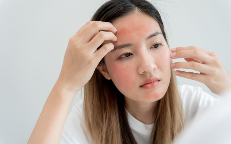 Tự ý bóc vảy da: Khi da bắt đầu bong tróc, cảm giác ngứa hoặc muốn lột bỏ lớp da chết có thể rất khó chịu.