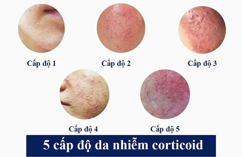Khi ngưng dùng, da nổi mụn đỏ, ngứa rát