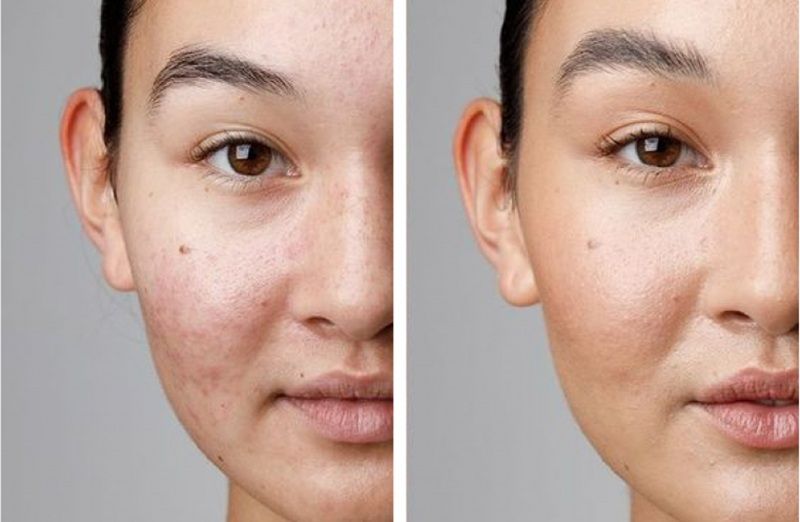 Cải thiện thâm mụn, nám, tàn nhang