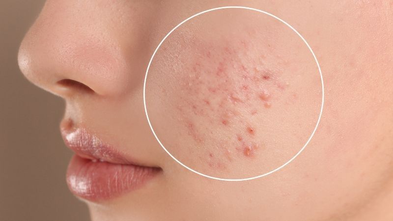 Cách chọn Toner cho Da Mụn