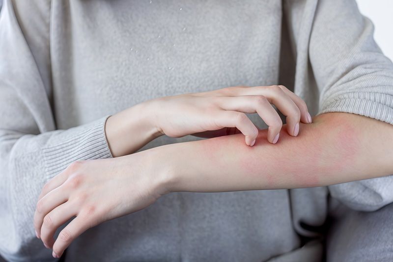 Một số người có thể dị ứng với dầu dừa, gây ra các biểu hiện như nổi mẩn đỏ, ngứa, hoặc khó chịu ở hệ tiêu hóa