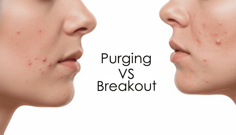 Phân biệt: Purging (Đẩy mụn) và Breakout (Kích ứng/Dị ứng)