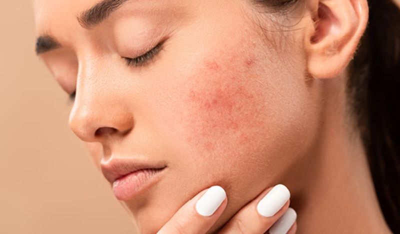 Mỹ phẩm gây kích ứng, mẩn đỏ, ngứa rát