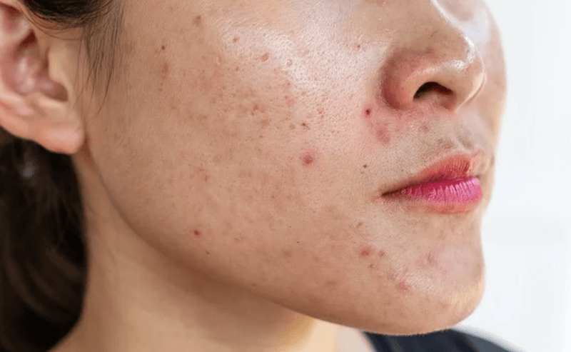 Nên chọn loại có khả năng thẩm thấu nhanh, không gây nhờn rít, không làm bí tắc lỗ chân lông