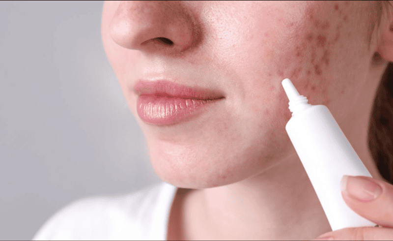 Đối với các nốt mụn viêm, sưng đỏ, bạn có thể sử dụng các sản phẩm chấm mụn có chứa Salicylic Acid, Benzoyl Peroxide hoặc Tea Tree Oil.