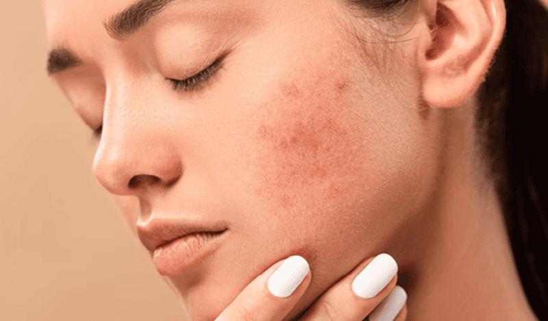 Dấu hiệu nhận biết da nhạy cảm với nắng sau khi dùng sữa rửa mặt