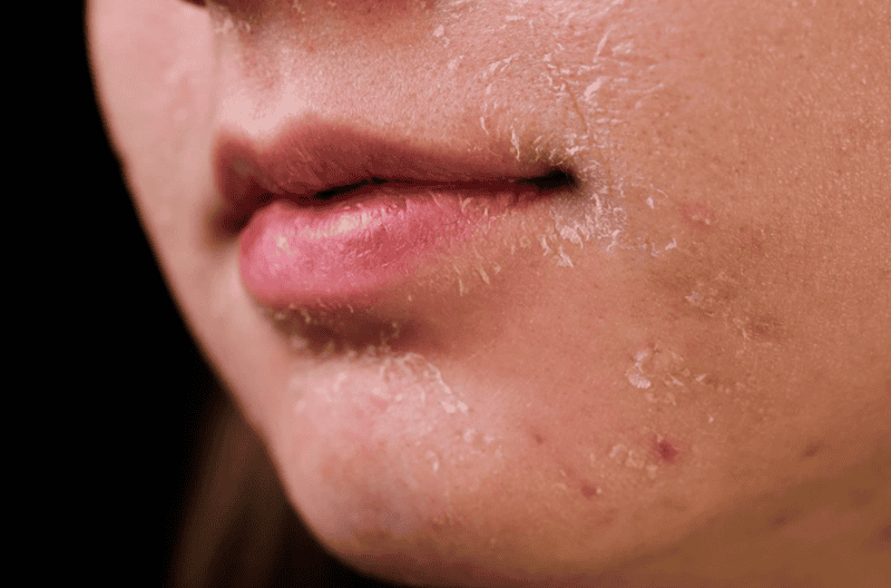 Khô da, bong tróc và đỏ rát