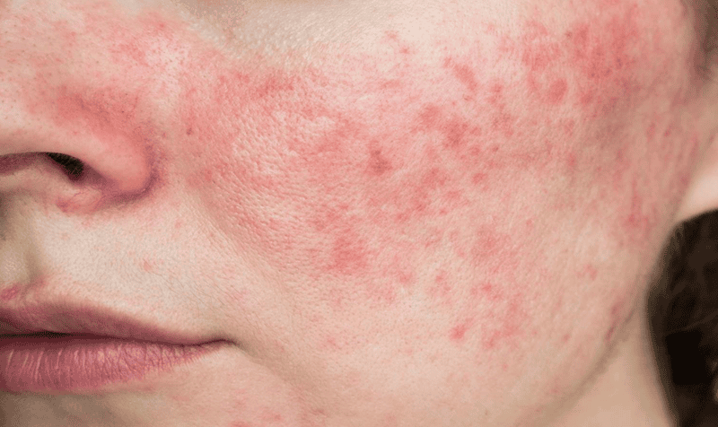 Những rủi ro khi lạm dụng nước muối trị mụn