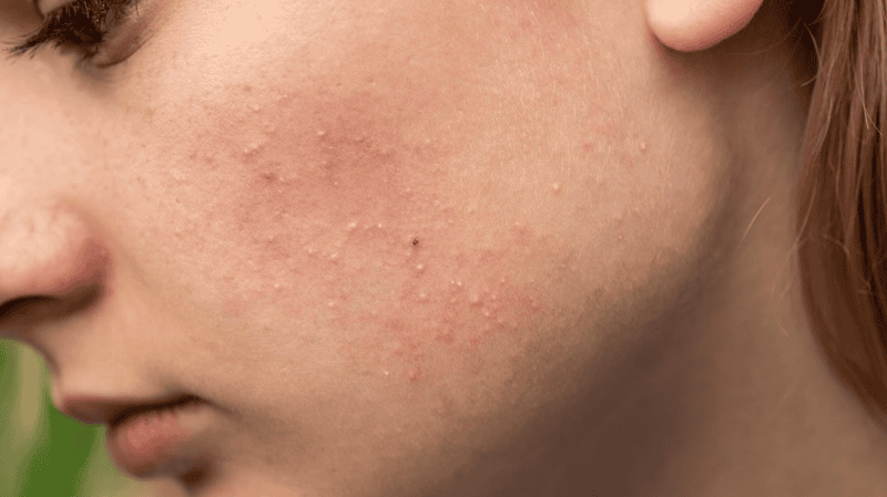 Bỏ qua bước khóa ẩm