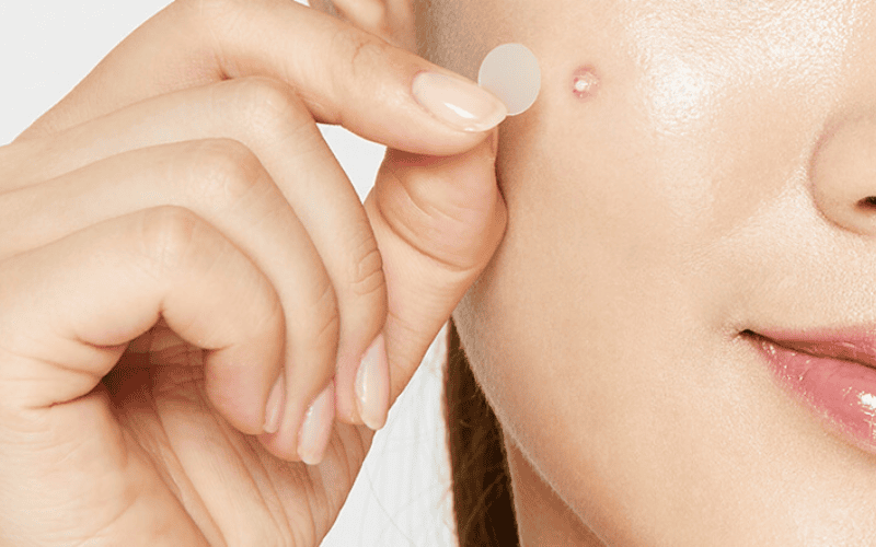 Miếng dán còn tạo môi trường khô thoáng, giúp da phục hồi tự nhiên mà không cần nặn