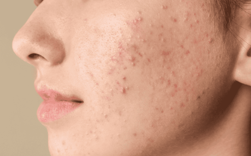 Với những ai sở hữu làn da dầu, dễ nổi mụn thì BHA chính là “trợ thủ đắc lực” giúp cải thiện tình trạng da