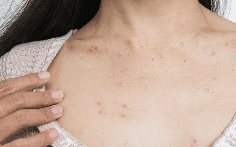 Dị ứng mỹ phẩm thường xuất hiện nhanh chóng chỉ sau vài giờ hoặc vài ngày sử dụng sản phẩm mới
