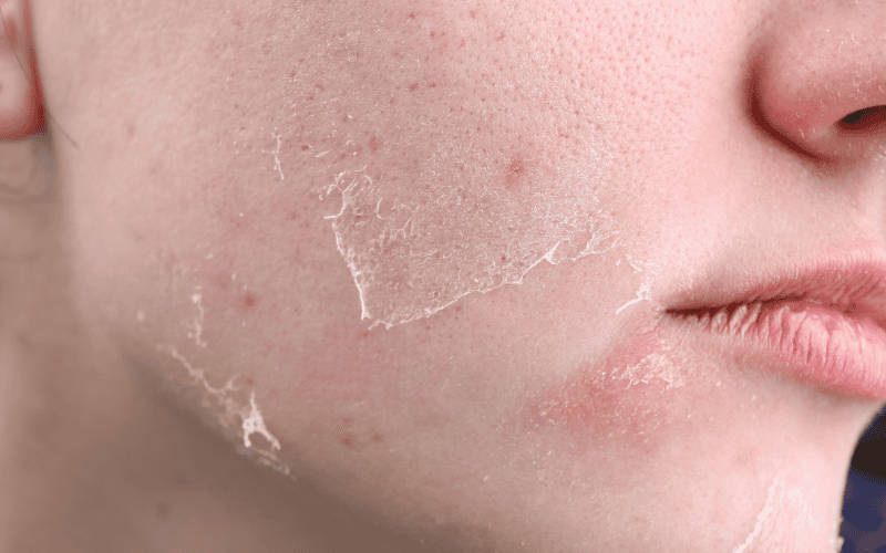 Nếu sữa rửa mặt có độ pH quá cao, chúng sẽ làm mất đi lớp dầu tự nhiên, khiến da khô căng, bong tróc và dễ nhạy cảm hơn