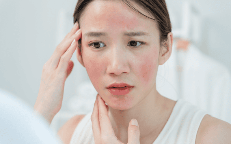 Sau khi đắp mặt nạ sữa chua, nếu bạn thấy da có những phản ứng bất thường thì rất có thể da đang bị kích ứng hoặc dị ứng