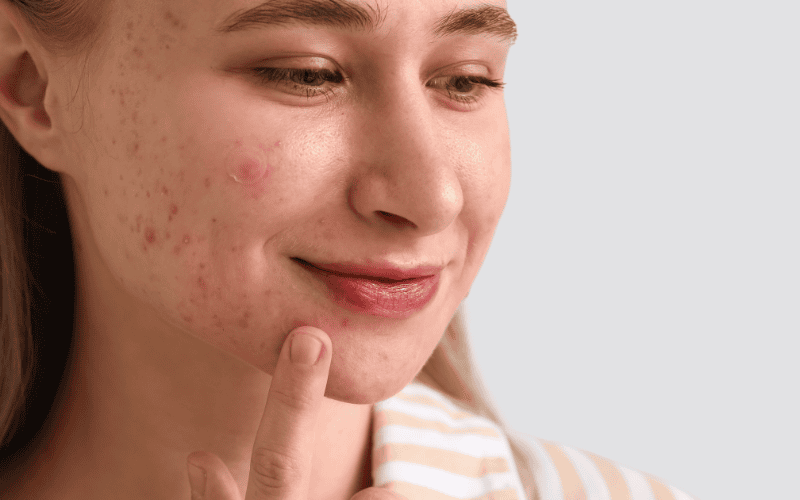 Nếu sử dụng miếng dán mụn sai thời điểm còn khiến da bị kích ứng hoặc làm mụn trở nên nặng hơn