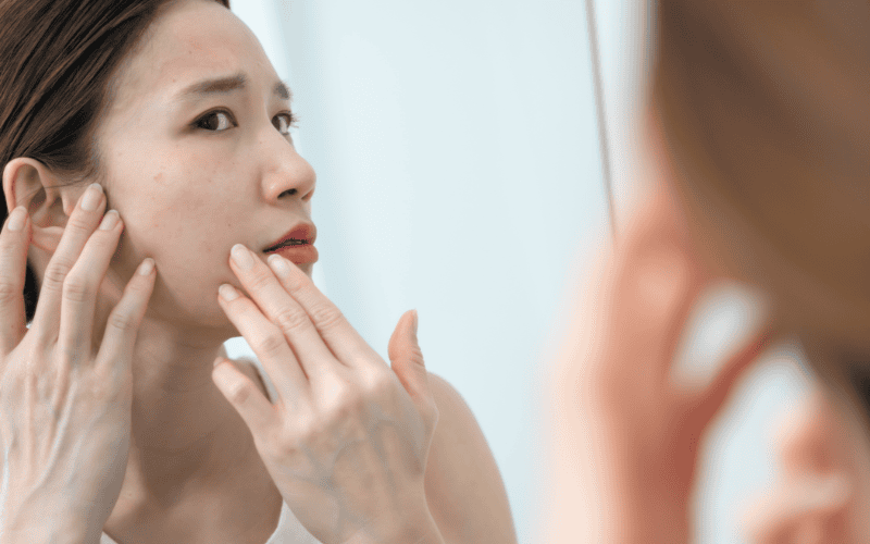 Mặt nạ đất sét còn được đánh giá cao trong việc chăm sóc da mụn