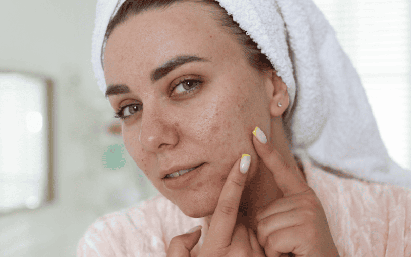 Để routine chăm sóc da mụn phát huy hiệu quả tốt nhất cần ghi nhớ một số nguyên tắc