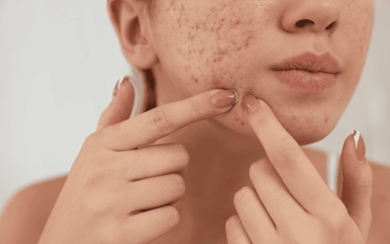 Việc nặn mụn không đúng cách khiến da tổn thương, để lại thâm, sẹo rỗ và thậm chí lan mụn sang vùng da khác