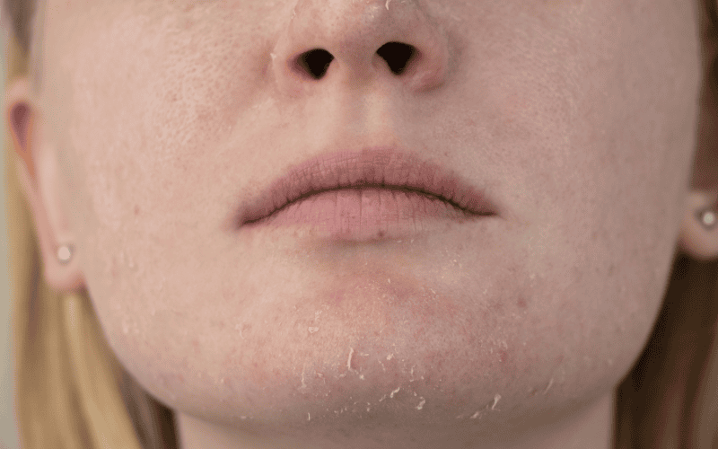 Khi bước vào mùa đông làn da phải đối mặt với nhiều yếu tố khiến độ ẩm tự nhiên bị suy giảm nghiêm trọng