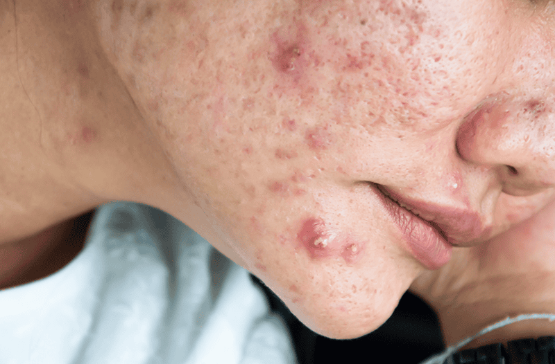 Mụn nang là những khối u lớn, mềm hoặc cứng, chứa đầy mủ cùng dịch lỏng, nằm rất sâu dưới bề mặt da