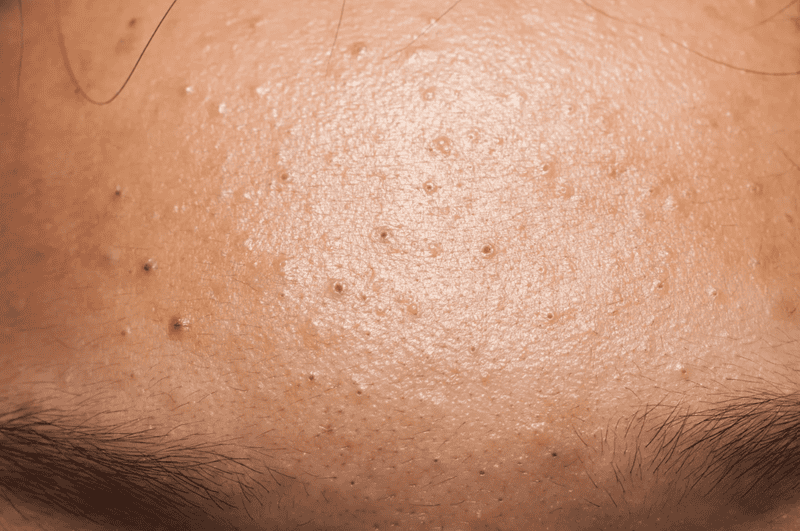 Mụn ẩn là những nốt sần nhỏ, cứng, có kích thước tương đương hạt gạo hoặc nhỏ hơn