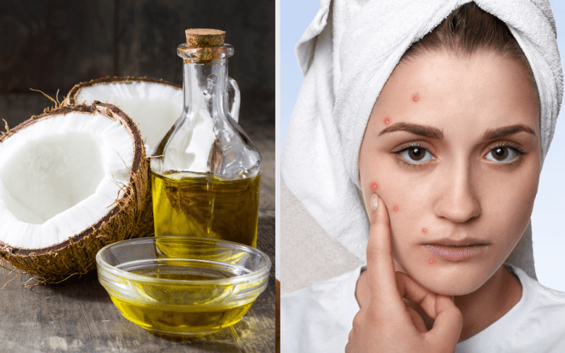 Tại sao bôi dầu dừa lại bị ngứa? Dầu dừa vẫn có thể gây ngứa hoặc kích ứng ở một số người