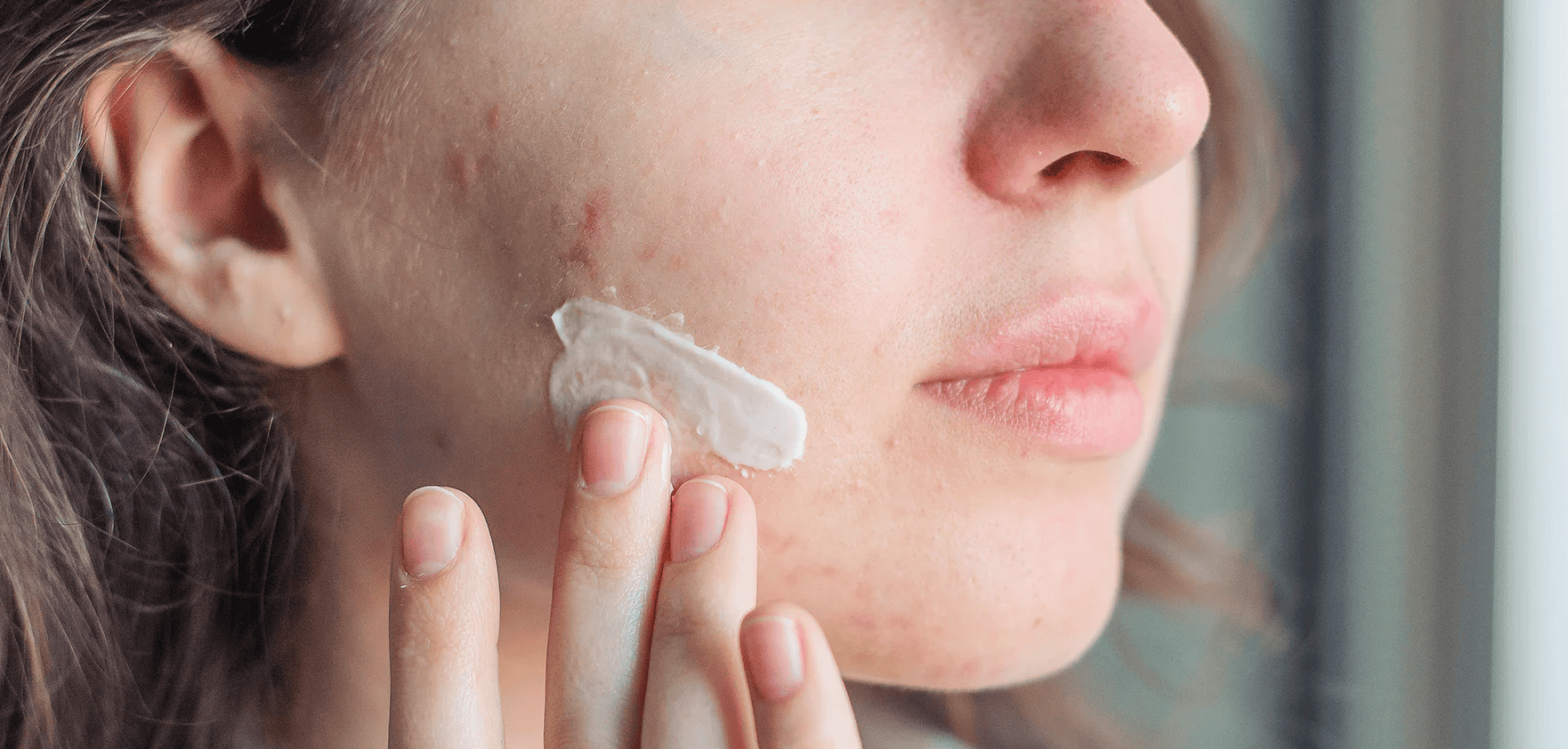 bôi kem trị mụn bao lâu thì rửa mặt hình 5.png