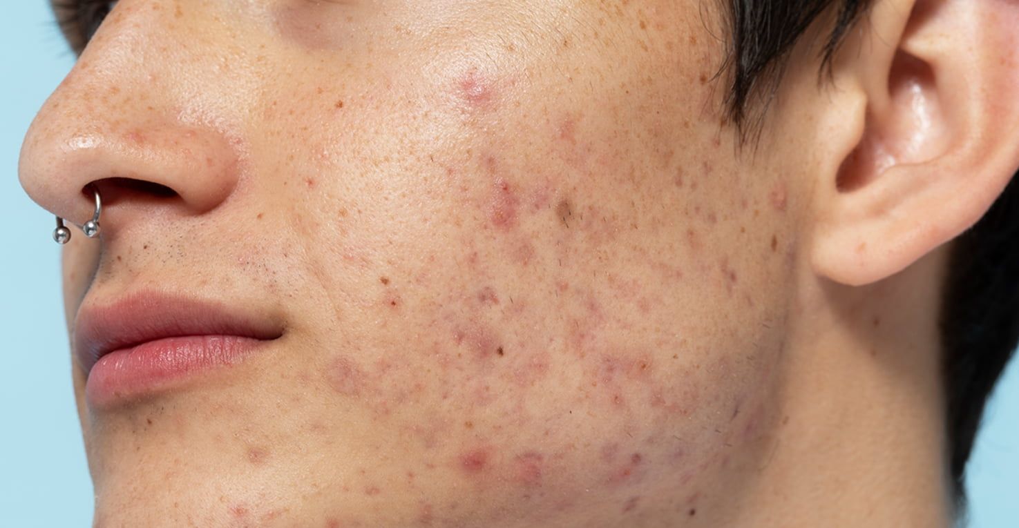 Các bước skincare cho nam da dầu mụn