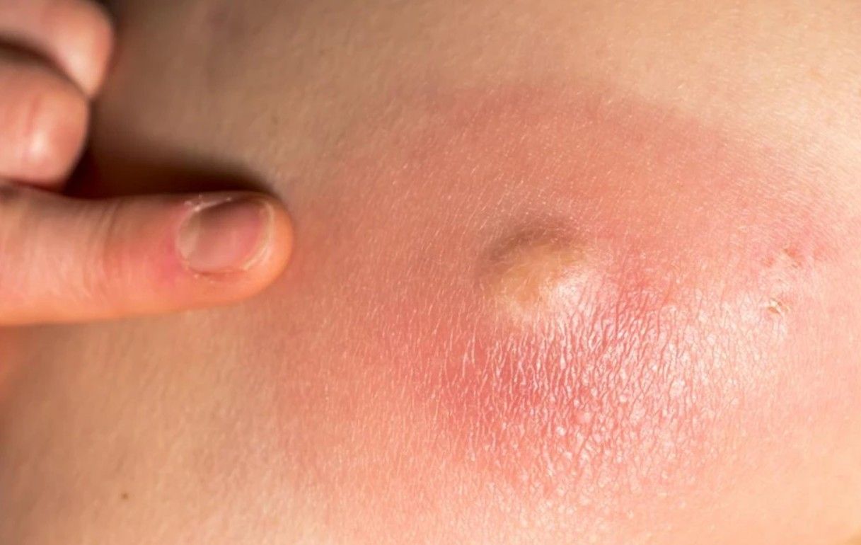 Mụn nhọt là một dạng nhiễm trùng da cấp tính