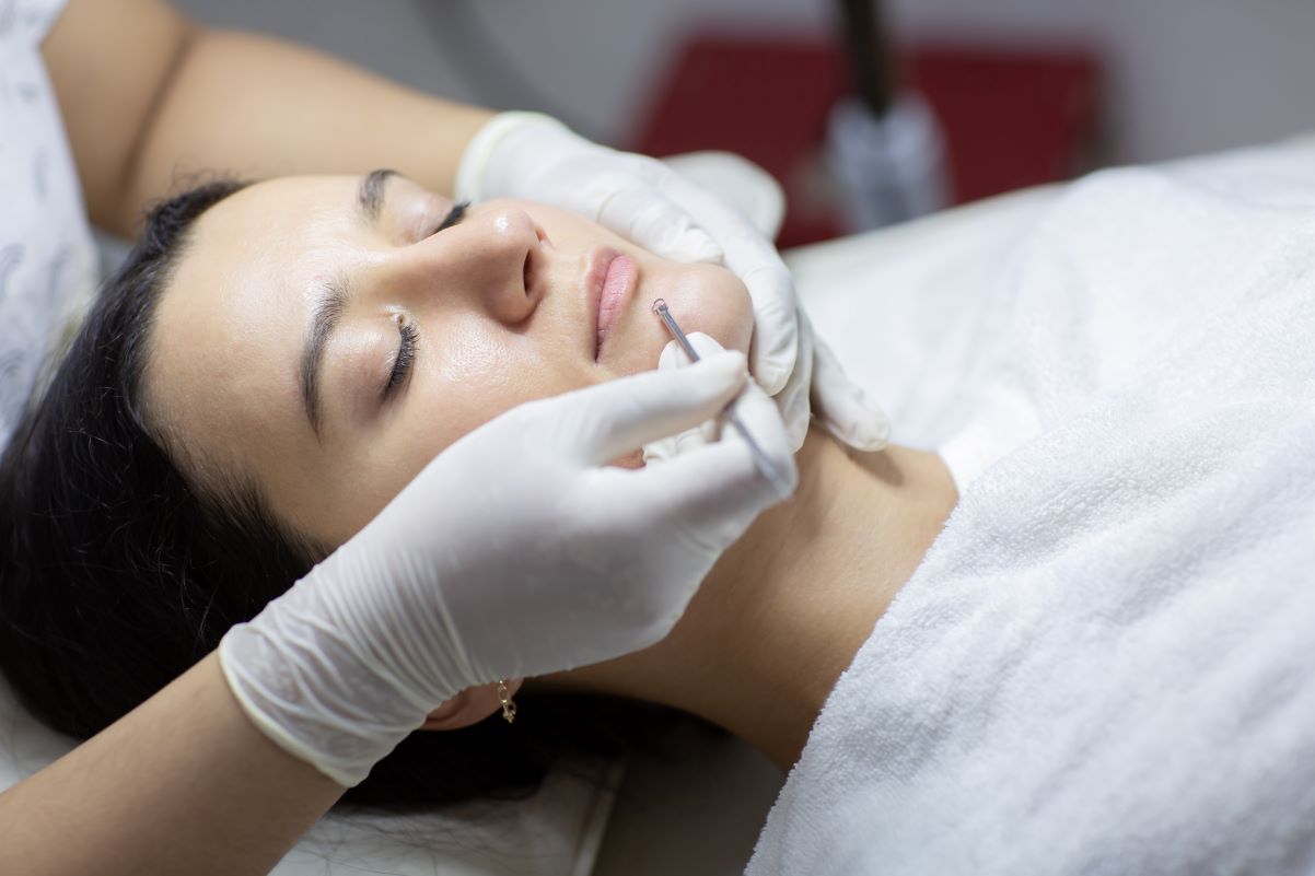 Điều trị mụn không viêm bằng cách lấy nhân mụn