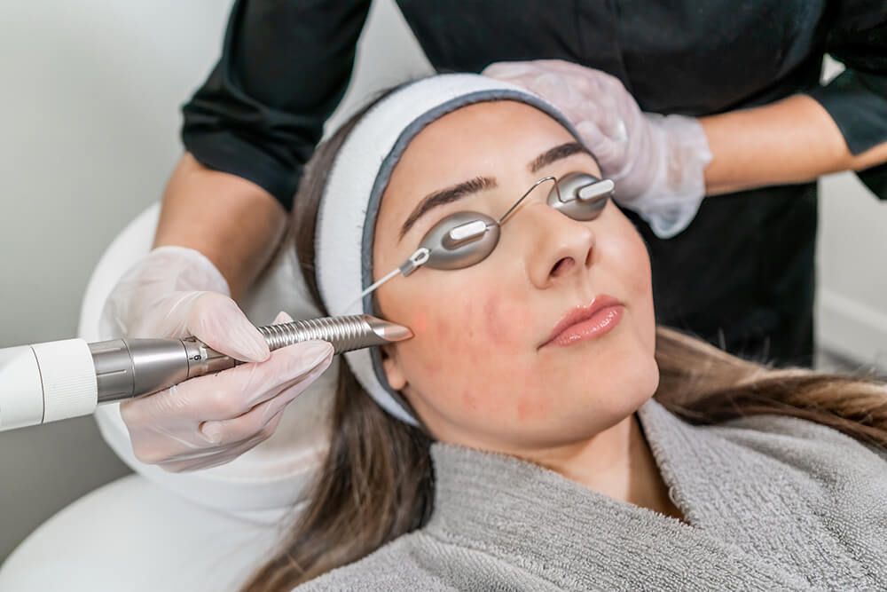 Laser mụn viêm để diệt khuẩn, giảm sưng