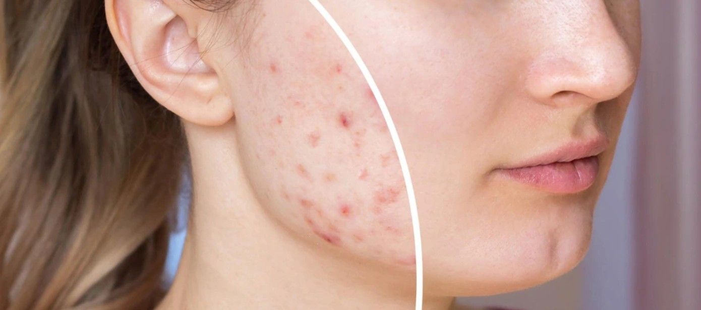 Hiểu đúng về các loại mụn trên mặt là bước đầu tiên để điều trị mụn