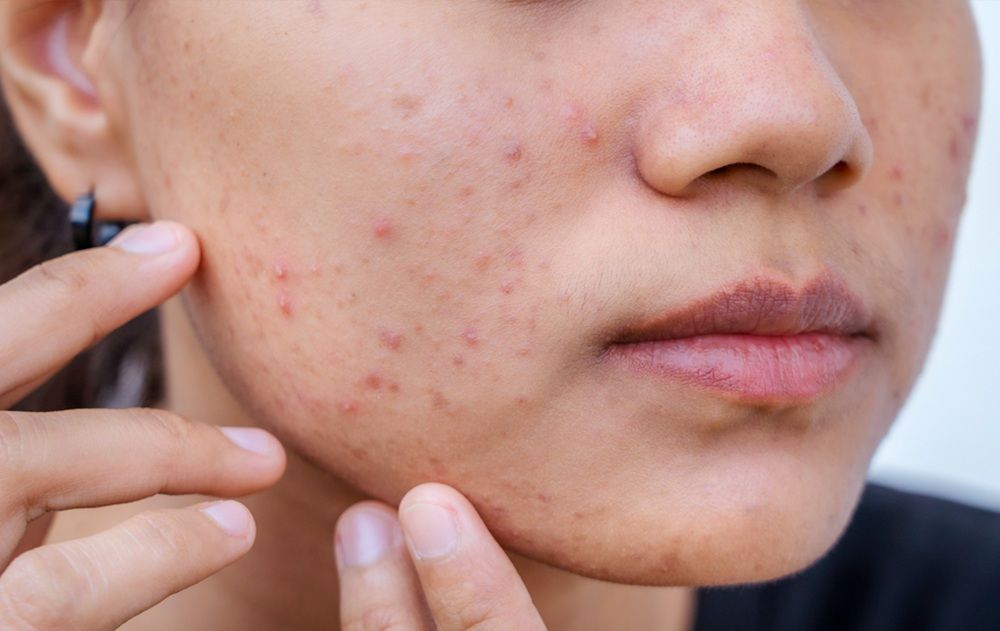 Những nguyên nhân phổ biến gây mụn trên mặt