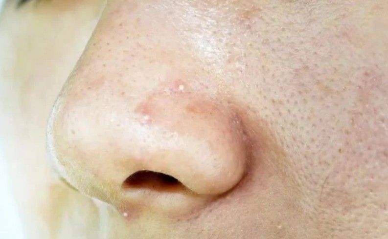 Mụn đầu trắng là một dạng mụn trứng cá không viêm khá phổ biến