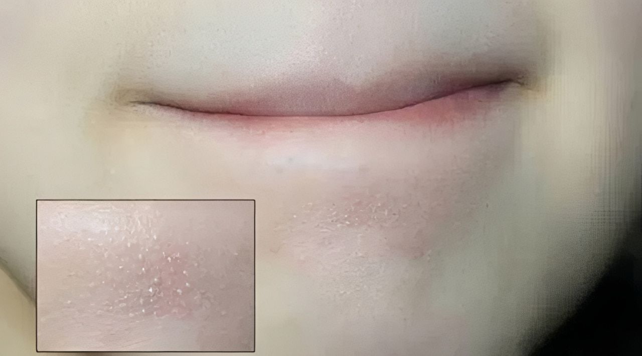 Mụn cám thực chất là một dạng nhẹ của mụn trứng cá