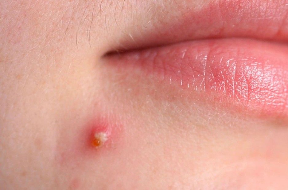 Mụn bọc là một trong những dạng mụn trứng cá viêm nặng nhất