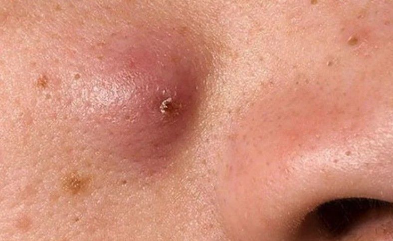 Mụn nang có thể xuất hiện riêng lẻ hoặc thành từng cụm