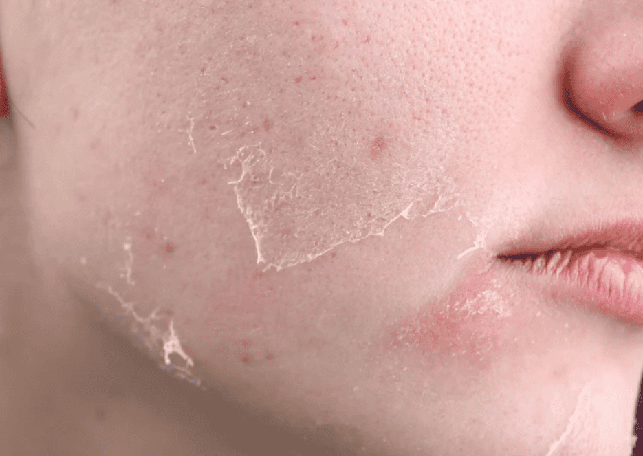 cách chăm sóc da khô mùa đông hình 3.png