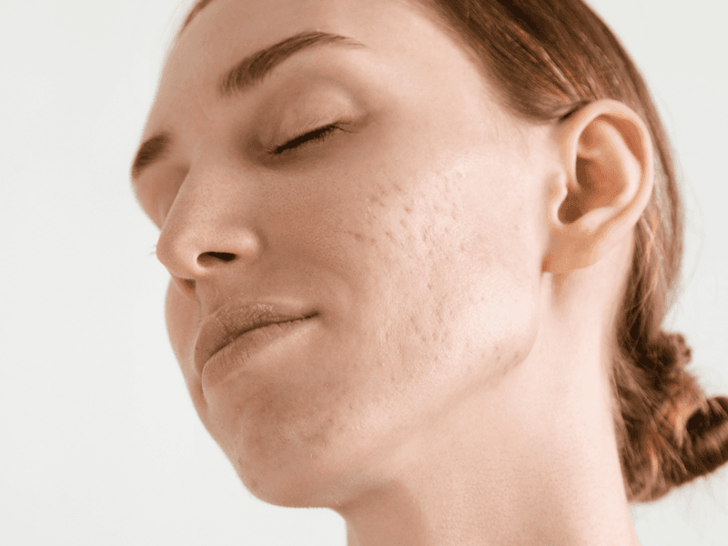 Không nên sử dụng mật ong để trị sẹo rỗ nếu bạn bị dị ứng mật ong