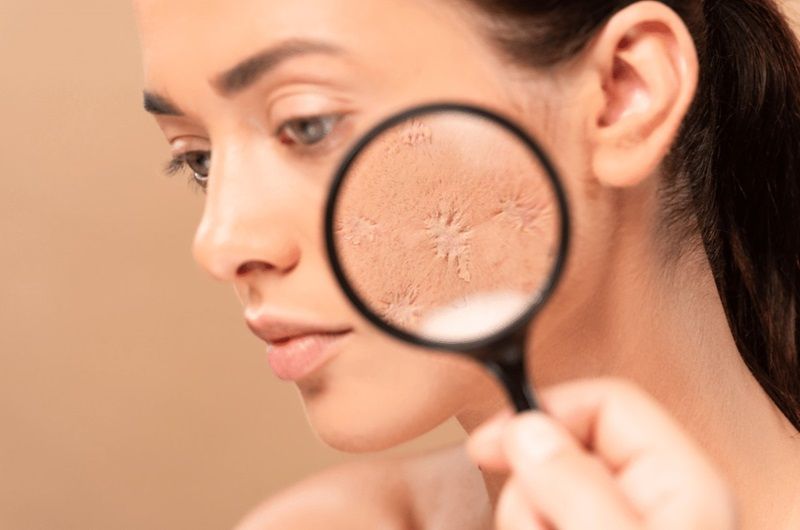 Sẹo lâu năm là một thách thức điều trị khá phức tạp