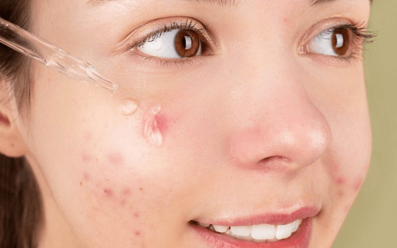 Da mụn có nên dùng serum B5 không?