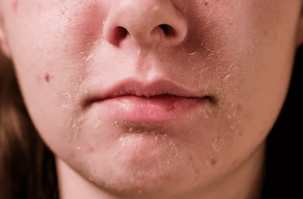 da khô nứt nẻ vào mùa đông hình 1.png